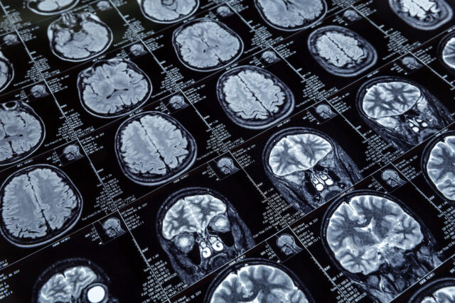 brain