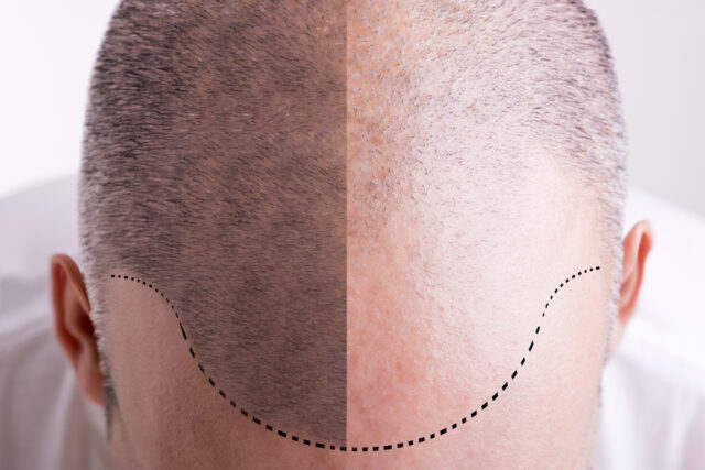 hairgrowth