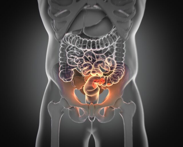 Kolorektalcancer