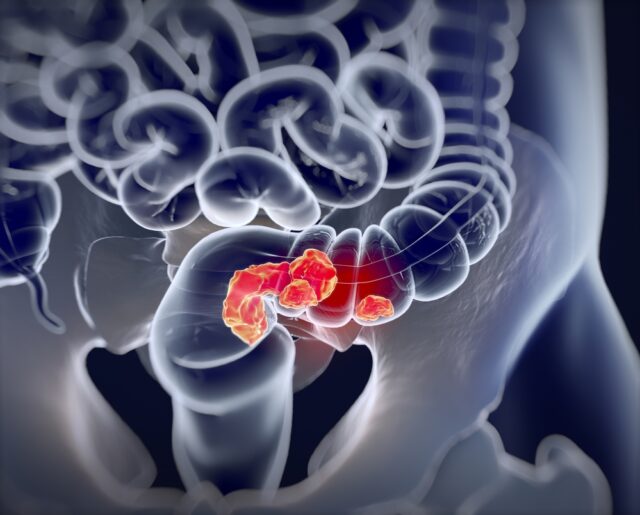 ColorectalCancer