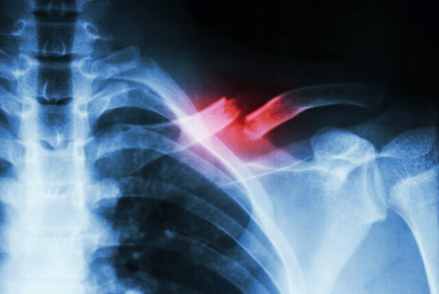 BrokenCallarbone