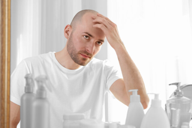 Alopecia