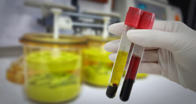 Hemcheck Hemolysis Hemcheck Hemolysis