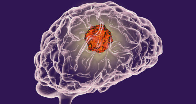 curasight-braincancer-deepdive BioStock looks at Curasight´s potential in brain cancer