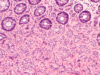 Positive results for Curasight in neuroendocrine cancer