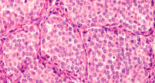 Curasight satsar på neuroendokrina tumörer